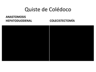 Quiste de Colédoco
ANASTOMOSIS
HEPATODUODENAL COLECISTECTOMÍA
 