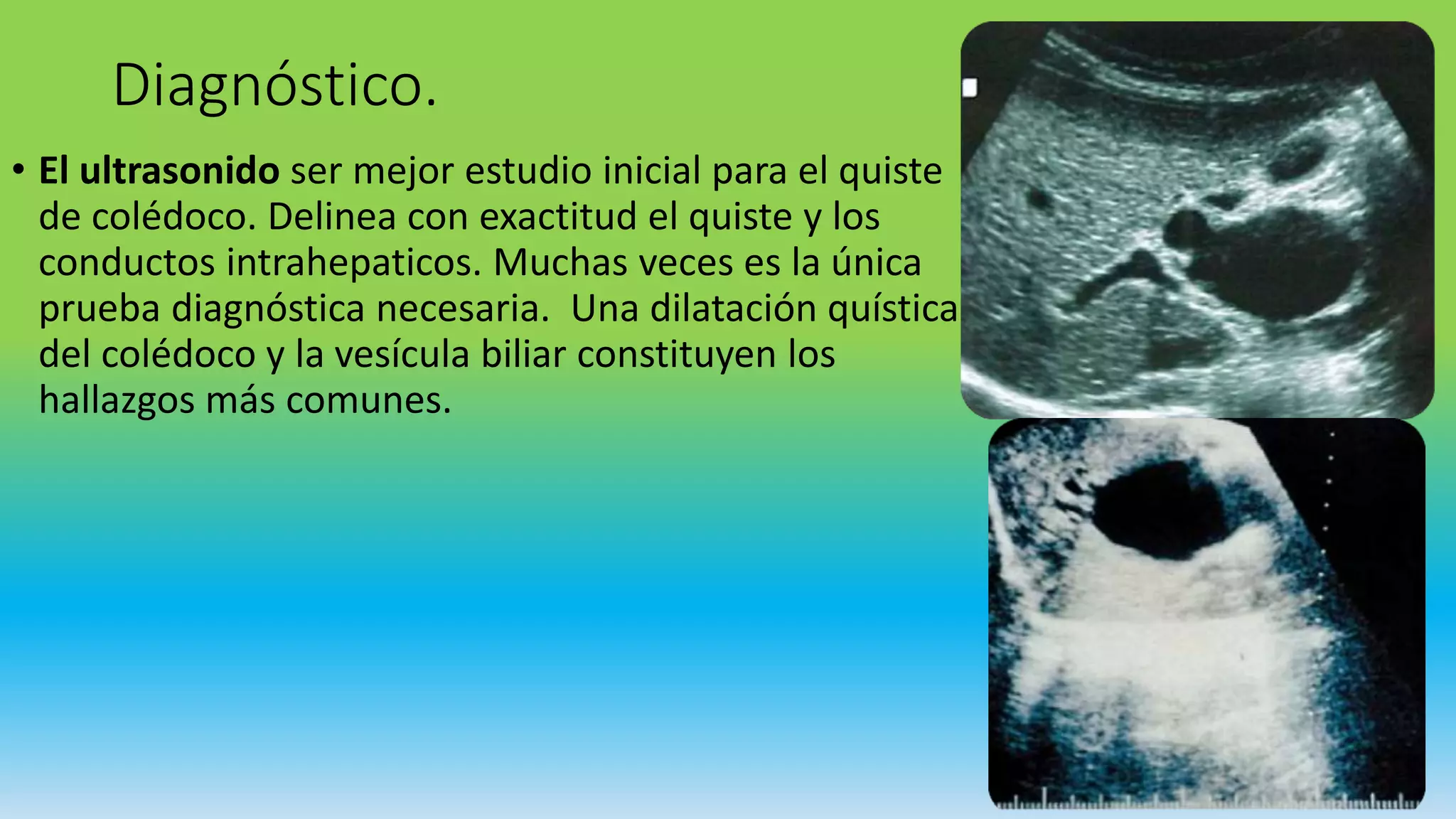 Quiste de coledoco | PPTX