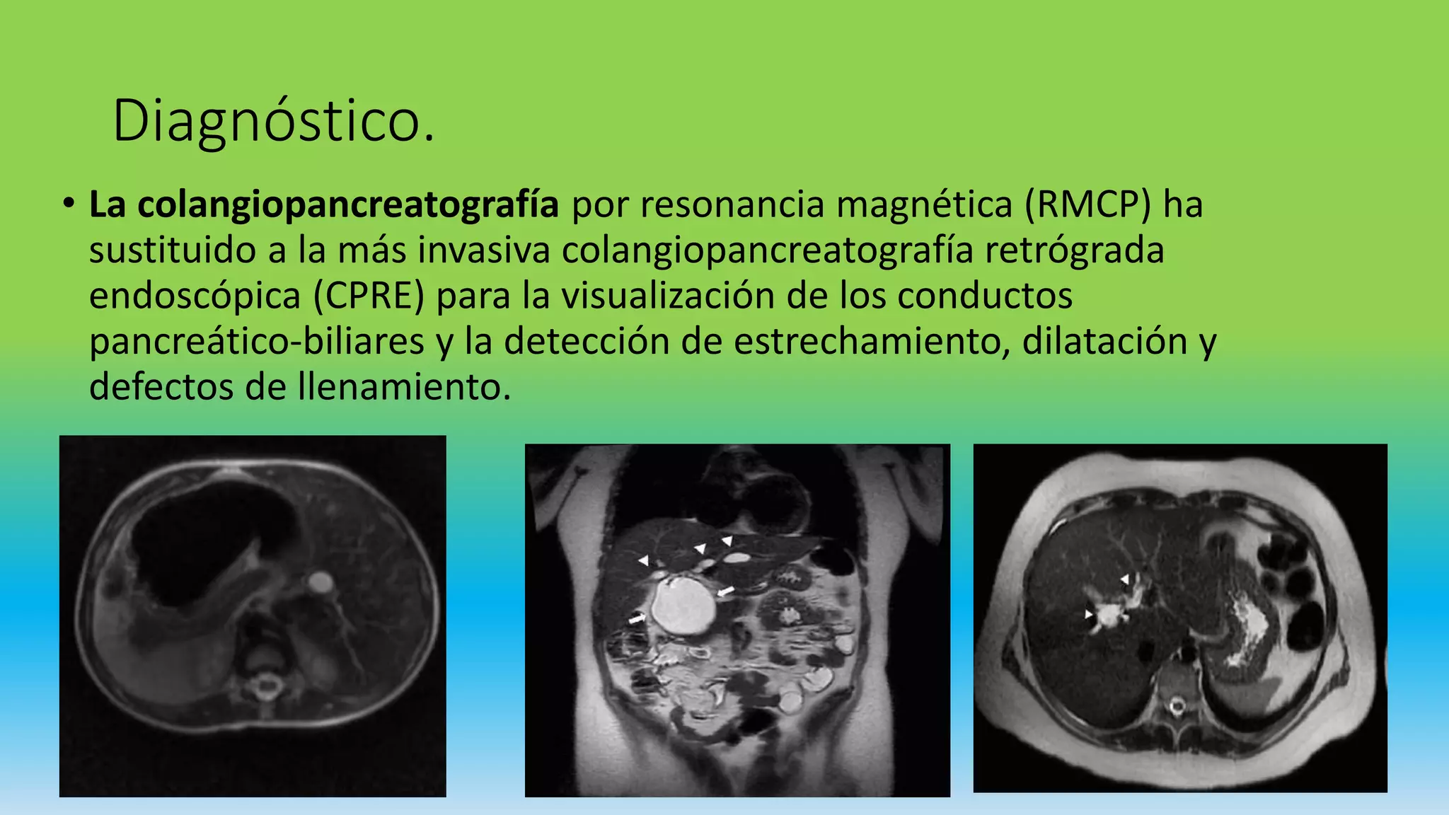 Quiste de coledoco | PPTX