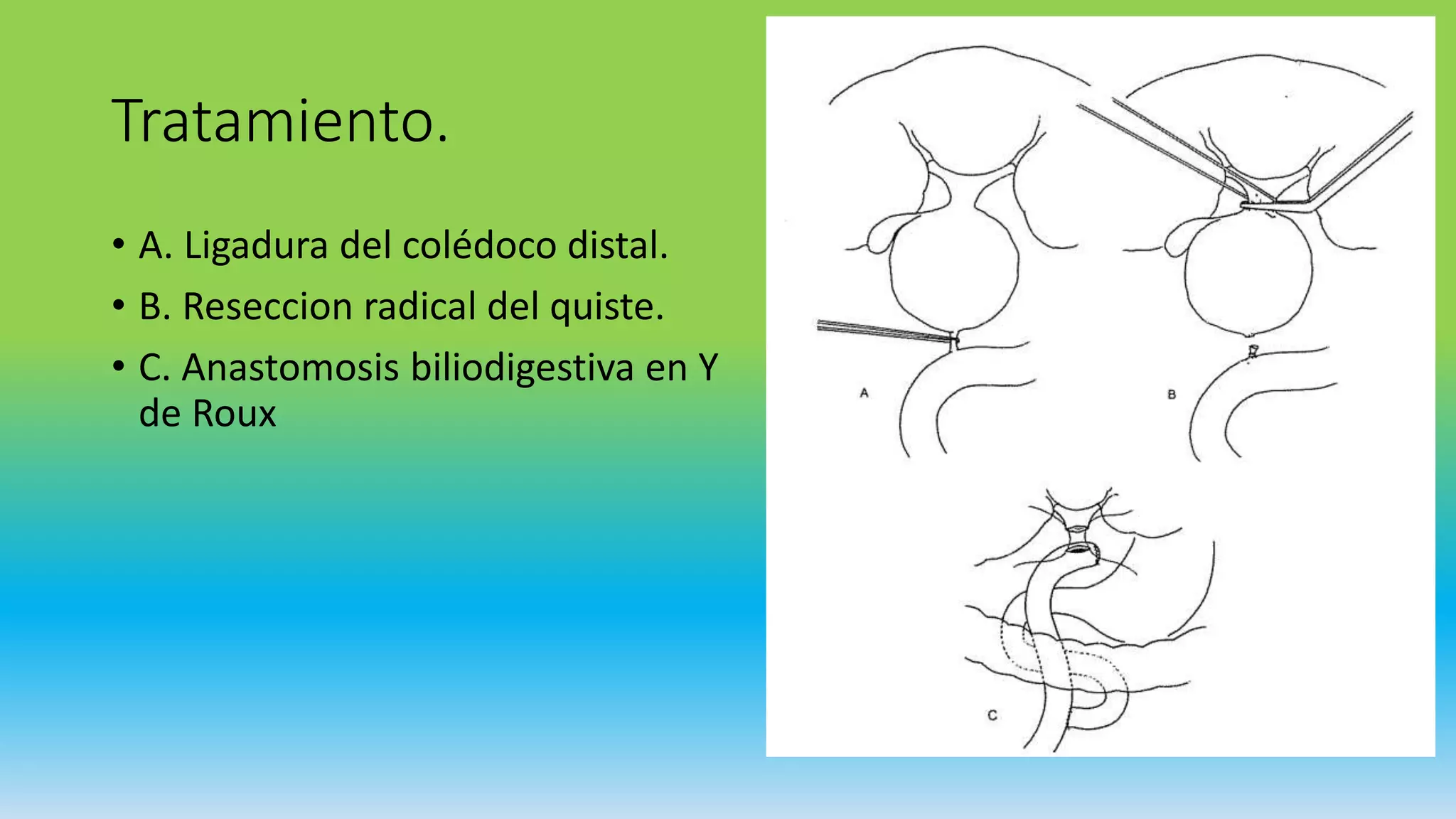 Quiste de coledoco | PPTX