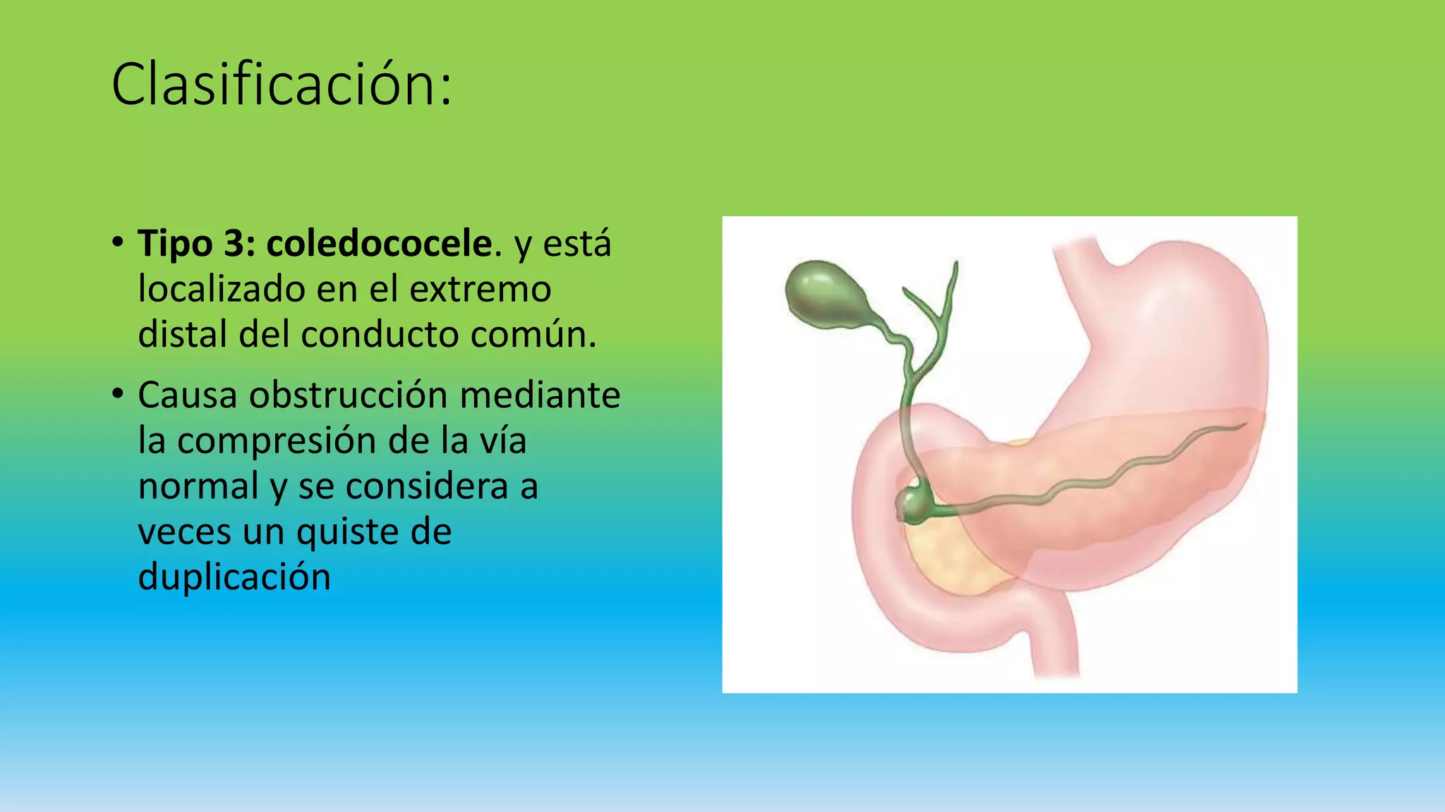 Quiste de coledoco | PPTX