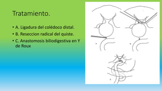 Tratamiento.
• A. Ligadura del colédoco distal.
• B. Reseccion radical del quiste.
• C. Anastomosis biliodigestiva en Y
de Roux
 
