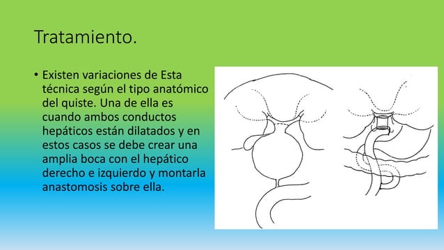 Quiste de coledoco | PPTX