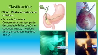 Quiste de coledoco | PPTX