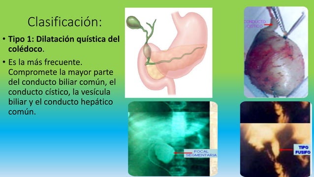Quiste de coledoco | PPTX