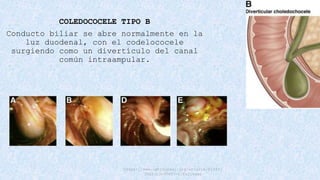 QUISTE DE COLEDOCO manejo, clasificación y tratamiento | PPTX