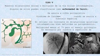 QUISTE DE COLEDOCO manejo, clasificación y tratamiento | PPTX