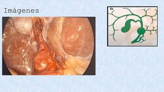 QUISTE DE COLEDOCO manejo, clasificación y tratamiento | PPTX