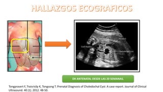 Tongprasert F, Traisrisilp K, Tongsong T. Prenatal Diagnosis of Choledochal Cyst: A case report. Journal of Clinical
Ultrasound. 40 (1). 2012. 48-50.
DX ANTENATAL DESDE LAS 20 SEMANAS.
 