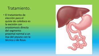 Quiste de Coledoco, TRATAMIENTO MEDICO Y QUIRUGICO | PPTX