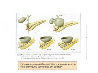 QUISTE DE COLEDOCO EN PACIENTE PEDIATRICO | PPTX
