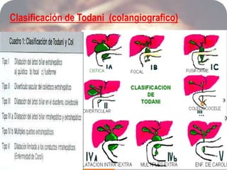 REVISION DE QUISTE COLEDOCO | PPTX