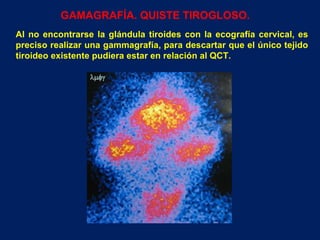 GAMAGRAFÍA. QUISTE TIROGLOSO. Al no encontrarse la glándula tiroides con la ecografía cervical, es preciso realizar una gammagrafía, para descartar que el único tejido tiroideo existente pudiera estar en relación al QCT.  