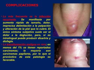 La más frecuente es la  infección recurrente .  Se manifiesta por aumento rápido de tamaño, dolor, imprecisa delimitación a la palpación y alteración de la piel que lo cubre. El único síntoma subjetivo suele ser el dolor a la deglución, pero, si es intralingual puede producir disartria y disfagia.  La  transformación maligna  es rara ; en menos del 1% se tienen reportados carcinomas; la mayoría son carcinomas papilares, por lo que el pronóstico de esta patología es favorable.  COMPLICACIONES 