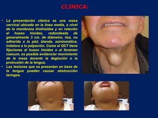 CLINICA: La presentación clásica es una masa cervical ubicada en la línea media, a nivel de la membrana tirohioidea y en relación al hueso hioides, redondeada de generalmente 3 cm. de diámetro, lisa, no adherida a la piel, blanda, asintomática, indolora a la palpación. Como el QCT tiene fijaciones al hueso hioides o al foramen caecum, es posible evidenciar movimiento de la masa durante la deglución o la protrusión de la lengua. Las lesiones que se presentan en base de la lengua pueden causar obstrucción laríngea.  