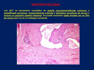 HISTOPATOLOGIA Los QCT se encuentran revestidos de  epitelio pseudoestratificado columnar  o  estratificado escamoso ,  ocasionalmente cuboidal  y  glándulas secretoras de mucus  e  incluso un pequeño epitelio intestinal . Se puede encontrar  tejido tiroideo (en un 25% de casos)  pero no es un hallazgo constante. 