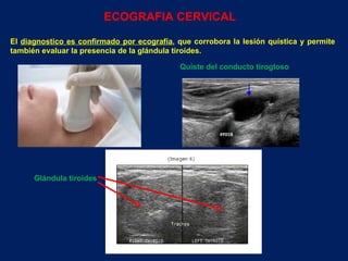 El  diagnostico es confirmado por ecografía , que corrobora la lesión quística y permite también evaluar la presencia de la glándula tiroides.  ECOGRAFIA CERVICAL Glándula tiroides Quiste del conducto tirogloso 