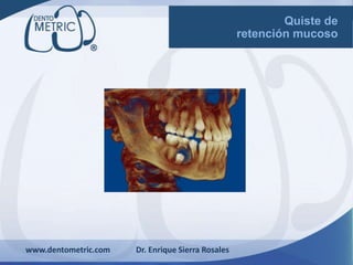 www.dentometric.com Dr. Enrique Sierra Rosales
Quiste de
retención mucoso
 