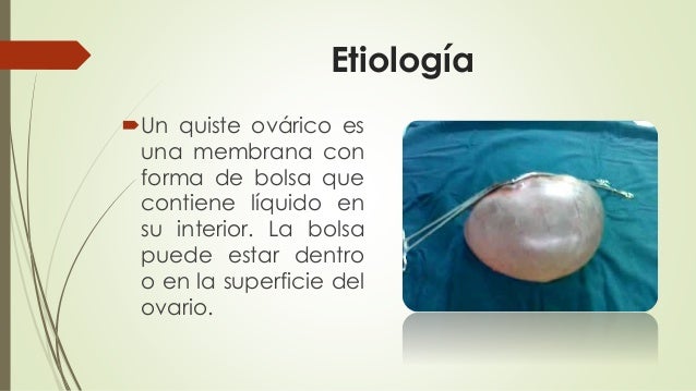 quiste-de-ovario