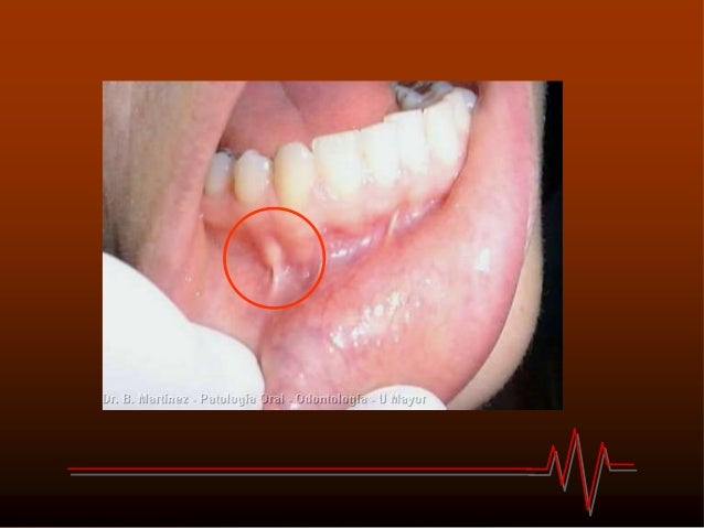 Quiste gingival