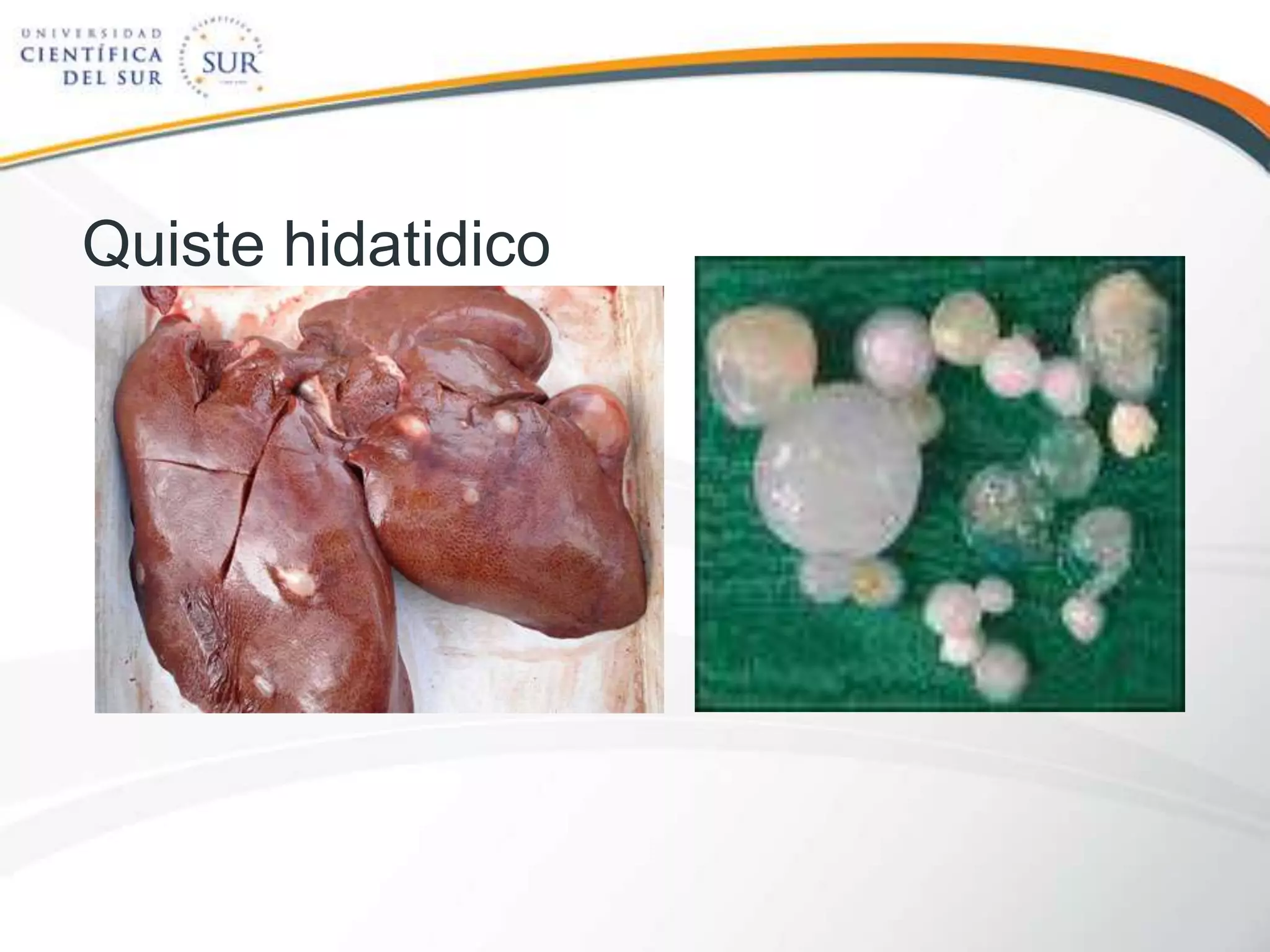 Quiste hidatidico