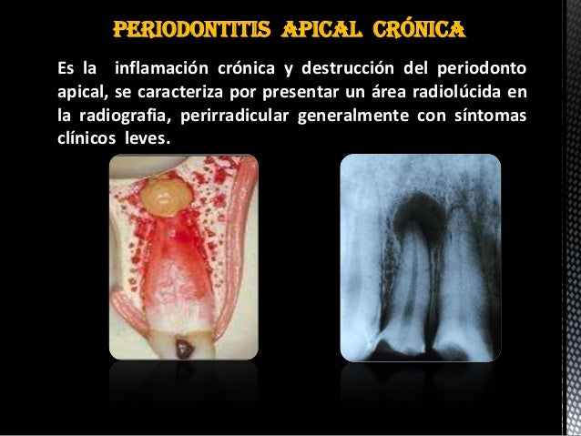 Periodontitis apical cronica pdf