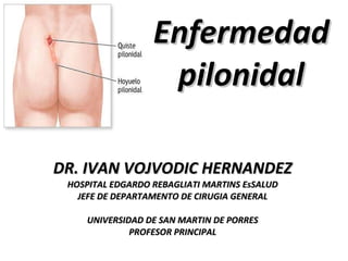 Enfermedad pilonidal DR. IVAN VOJVODIC HERNANDEZ HOSPITAL EDGARDO REBAGLIATI MARTINS EsSALUD JEFE DE DEPARTAMENTO DE CIRUGIA GENERAL UNIVERSIDAD DE SAN MARTIN DE PORRES PROFESOR PRINCIPAL 