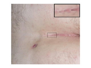 Enfermedad pilonidal | PPT