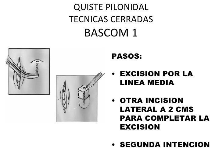 What Is Bascom Ii Procedure? | Pilonidal Sinus Management; Bascom Flap ...