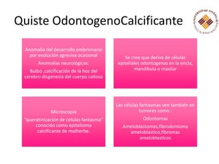 Quiste OdontogenoCalcificante
