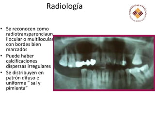 Radiología Se reconocen como radiotransparenciaunilocular o multilocular con bordes bien marcados Puede haber calcificaciones dispersas irregulares Se distribuyen en patrón difuso e uniforme “ sal y pimienta”