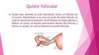 Quiste folicular
 Cada mes, durante el ciclo menstrual, crece un folículo en
el ovario, liberándose a su vez un óvulo de este folículo, lo
cual se denomina ovulación. Si el folículo no logra abrirse y
liberar un óvulo, el líquido permanece dentro del folículo y
forma un quiste, el cual se denomina quiste folicular.
 