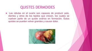 QUISTES DERMOIDES
 Las células en el ovario son capaces de producir pelo,
dientes y otros de los tejidos que crecen, los cuales se
vuelven parte de un quiste ovárico en formación. Estos
quistes se pueden volver grandes y causar dolor.
 