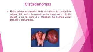 Cistadenomas
 Estos quistes se desarrollan de las células de la superficie
exterior del ovario. A menudo están llenos de un líquido
acuoso o un gel espeso y pegajoso. Se pueden volver
grandes y causar dolor.
 