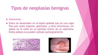 Tipos de neoplasias benignas
 Adenomas:
 Estos se desarrollan en el tejido epitelial que es una capa
fina que cubre órganos, glándulas, y otras estructuras. Un
pólipo en el colon es un ejemplo común de un adenoma.
Estos pólipos se pueden extirpar quirúrgicamente.
 