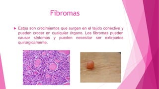 Fibromas
 Estos son crecimientos que surgen en el tejido conectivo y
pueden crecer en cualquier órgano. Los fibromas pueden
causar síntomas y pueden necesitar ser extirpados
quirúrgicamente.
 