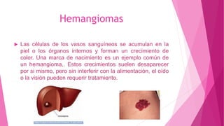 Hemangiomas
 Las células de los vasos sanguíneos se acumulan en la
piel o los órganos internos y forman un crecimiento de
color. Una marca de nacimiento es un ejemplo común de
un hemangioma,. Estos crecimientos suelen desaparecer
por si mismo, pero sin interferir con la alimentación, el oído
o la visión pueden requerir tratamiento.
 