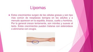 Lipomas
 Estos crecimientos surgen de las células grasas y son tipo
mas común de neoplasias benigna en los adultos y a
menudo aparecen en la espalda, brazos, cuello u hombros.
Por lo general crecen lentamente, son móviles y suaves al
tacto. Estos crecimientos pueden tratarse con esteroideos
o eliminarse con cirugía.
 