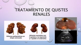 TRATAMIENTO DE QUISTES
RENALES
 