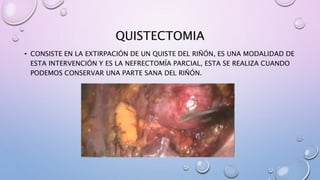 QUISTECTOMIA
• CONSISTE EN LA EXTIRPACIÓN DE UN QUISTE DEL RIÑÓN, ES UNA MODALIDAD DE
ESTA INTERVENCIÓN Y ES LA NEFRECTOMÍA PARCIAL, ESTA SE REALIZA CUANDO
PODEMOS CONSERVAR UNA PARTE SANA DEL RIÑÓN.
 