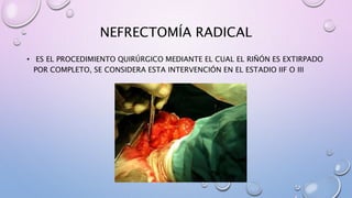 NEFRECTOMÍA RADICAL
• ES EL PROCEDIMIENTO QUIRÚRGICO MEDIANTE EL CUAL EL RIÑÓN ES EXTIRPADO
POR COMPLETO, SE CONSIDERA ESTA INTERVENCIÓN EN EL ESTADIO IIF O III
 
