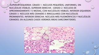 • SUPERIOR IZQUIERDA: GRADO 1: NÚCLEOS PEQUEÑOS, UNIFORMES, SIN
NUCLÉOLOS VISIBLES. SUPERIOR DERECHA : GRADO 2: NÚCLEOS DE
APROXIMADAMENTE 15 MICRAS, CON NUCLÉOLOS VISIBLES. INFERIOR IZQUIERDA:
GRADO 3: NÚCLEOS MÁS GRANDES E IRREGULARES CON NUCLÉOLOS
PROMINENTES. INFERIOR DERECHA: NÚCLEOS MÁS PLEOMÓRFICOS Y NUCLÉOLOS
GRANDES; EN ALGUNOS CASOS VEREMOS ÁREAS SARCOMATOIDES.
 