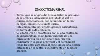 ONCOCITOMA RENAL
• Tumor que se origina del túbulo distal; se presume
de las células intercaladas del túbulo distal. El
clásico oncocitoma es, por definición, un tumor
benigno, sin potencial metastásico.
• Está compuesto, por células grandes eosinofílicas,
en forma de nidos celulares.
• Su citoplasma se caracteriza por su alto contenido
de mitocondrias, es un tumor rodeado de una
cápsula fibrosa bien definida y que, rara vez,
compromete la grasa perirrenal y el parénquima
renal. De color café claro al corte, posee una cicatriz
estrellada en el centro, especialmente en tumores
grandes.
 