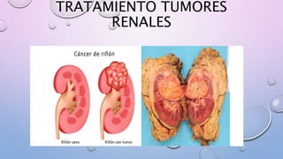 TRATAMIENTO TUMORES
RENALES
 
