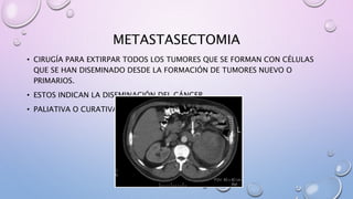 METASTASECTOMIA
• CIRUGÍA PARA EXTIRPAR TODOS LOS TUMORES QUE SE FORMAN CON CÉLULAS
QUE SE HAN DISEMINADO DESDE LA FORMACIÓN DE TUMORES NUEVO O
PRIMARIOS.
• ESTOS INDICAN LA DISEMINACIÓN DEL CÁNCER.
• PALIATIVA O CURATIVA
 
