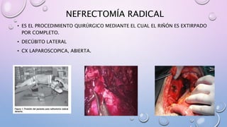 NEFRECTOMÍA RADICAL
• ES EL PROCEDIMIENTO QUIRÚRGICO MEDIANTE EL CUAL EL RIÑÓN ES EXTIRPADO
POR COMPLETO.
• DECÚBITO LATERAL
• CX LAPAROSCOPICA, ABIERTA.
 