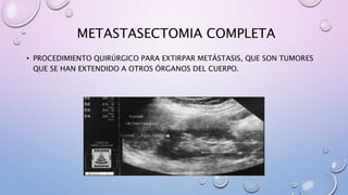 METASTASECTOMIA COMPLETA
• PROCEDIMIENTO QUIRÚRGICO PARA EXTIRPAR METÁSTASIS, QUE SON TUMORES
QUE SE HAN EXTENDIDO A OTROS ÓRGANOS DEL CUERPO.
 