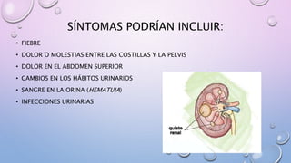 SÍNTOMAS PODRÍAN INCLUIR:
• FIEBRE
• DOLOR O MOLESTIAS ENTRE LAS COSTILLAS Y LA PELVIS
• DOLOR EN EL ABDOMEN SUPERIOR
• CAMBIOS EN LOS HÁBITOS URINARIOS
• SANGRE EN LA ORINA (HEMATUIA)
• INFECCIONES URINARIAS
 
