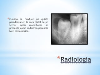 *
*Cuando se produce un quiste
paradental en la cara distal de un
tercer molar mandibular, se
presenta como radiotransparencia
bien circunscrita.
 