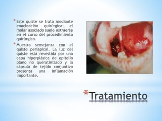 *
*Este quiste se trata mediante
enucleación quirúrgica; el
molar asociado suele extraerse
en el curso del procedimiento
quirúrgico.
*Muestra semejanza con el
quiste periapical. La luz del
quiste está revestida por una
capa hiperplásica de epitelio
plano no queratinizado y la
cápsula de tejido conjuntivo
presenta una inflamación
importante.
 